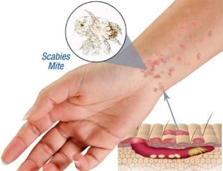 Dinkes Kota Pekanbaru Ajak Masyarakat Waspadai Penyakit Scabies